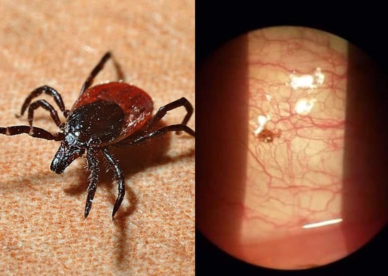 Después de retirar al insecto, el médico le dio al paciente antibióticos. (INTERNET)