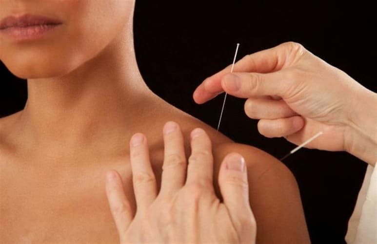 La acupunturista no informó a la paciente todos los riesgos del tratamiento. (INTERNET)
