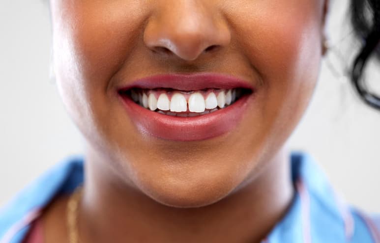 Apretar, rechinar o crujir los dientes son actos que se realizan de manera inconsciente y que puede tener repercusiones fuertes en tu salud dental. (ARCHIVO)