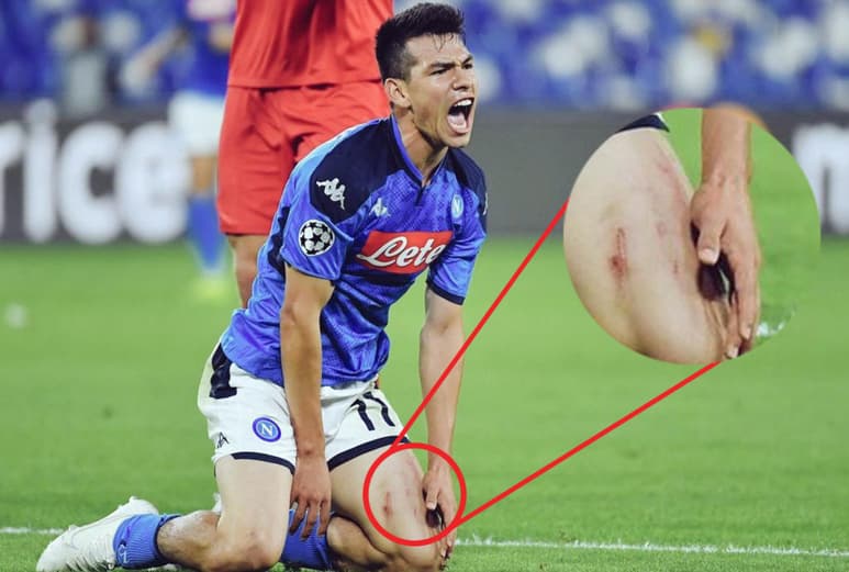 Las duras faltas sobre el mexicano se reflejaron en las piernas, las cuales mostraron hematomas, golpes y rasguños. (ARCHIVO)