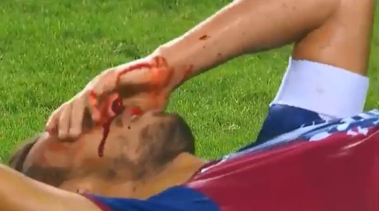 El futbolista de los Potros de Hierro, terminó teñido en sangre luego del golpe en su cara. (CORTESÍA)