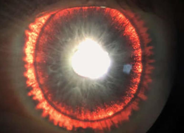 Una condición con riesgos como un aumento de la presión intraocular y daños en el nervio óptico. (INTERNET)