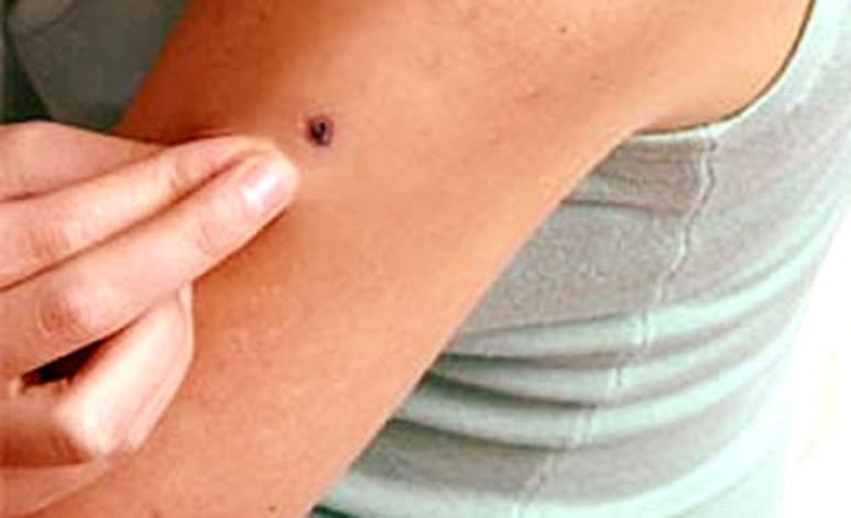 La dermatofibrosarcoma protuberans es un cáncer de piel poco frecuente, que aparece en la piel como un pequeño bulto, explica la Academia Americana de Dermatología (AAD). (ESPECIAL)