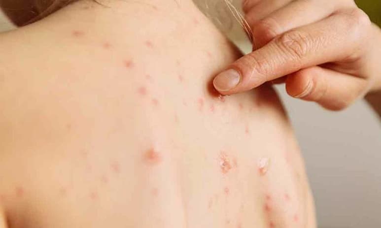 La epidermólisis ampollosa (EB), también conocida como piel de mariposa es una enfermedad rara que provoca que la piel se ampolle fácilmente. (ESPECIAL) 