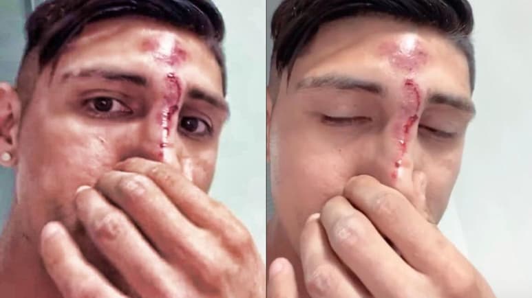 El exdelantero de Tigres y Guadalajara, mostró cómo quedó su rostro después de que estaba 'buscando un aluminio'. (ESPECIAL)
