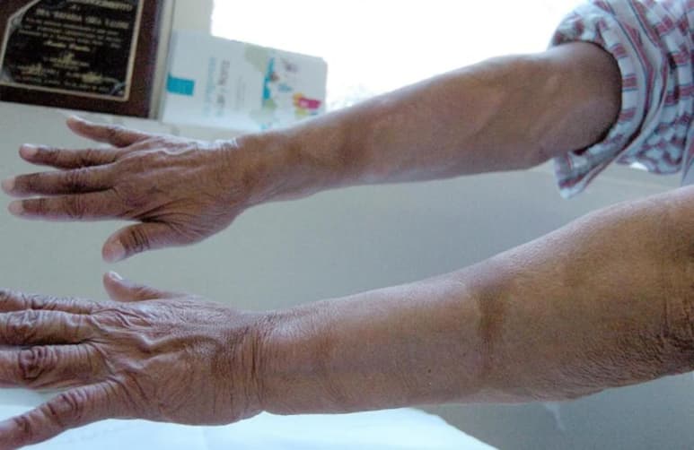 En Coahuila se registran hasta el momento dos casos de lepra, uno en la región laguna y el otro en Sabinas, sin que exista relación entre los pacientes contagiados.
(ARCHIVO)