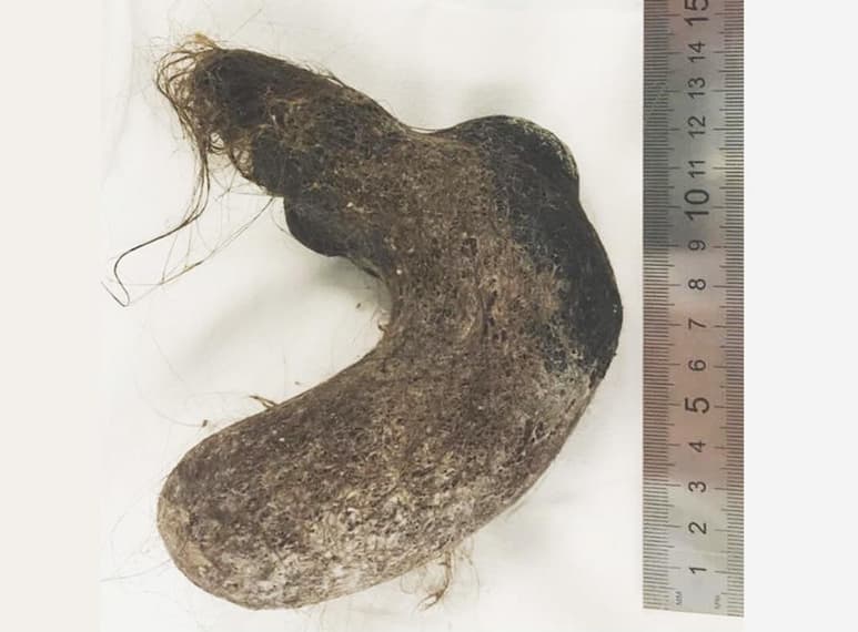 El cabello obstruía su tracto digestivo. (INTERNET)