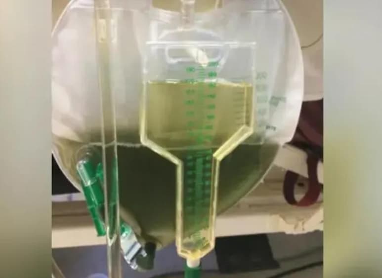 Un medicamento fue el causante de la decoloración de la orina, pero era algo benigno. (INTERNET)