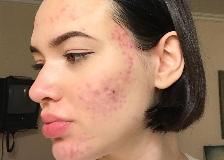 El acné es una enfermedad que se produce cuando las glándulas sebáceas producen más grasa de la normal. Los poros se tapan y se retienen las células muertas. (Instagram @ttempestaa.skin)
