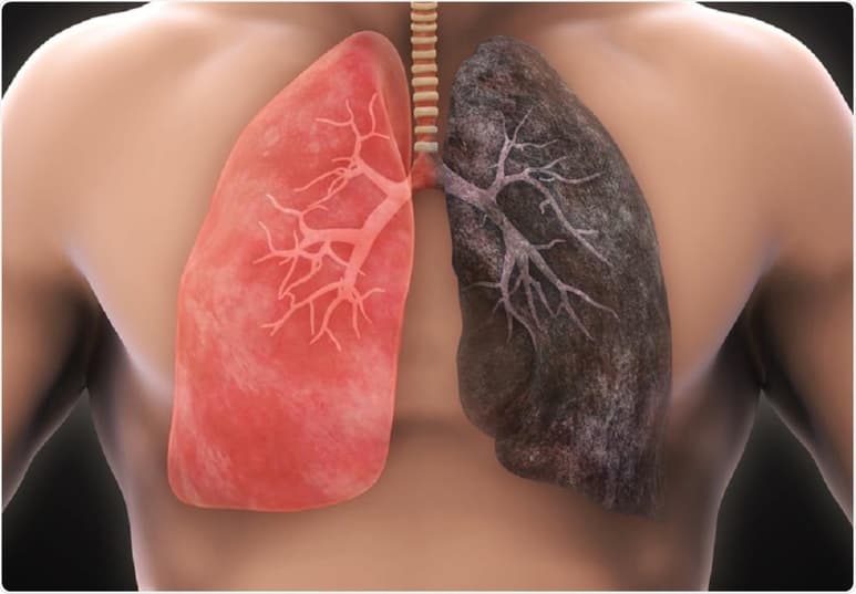 Estados Unidos registró nuevamente una caída anual récord en las muertes por cáncer y los expertos creen que se debe a los avances en la lucha contra el cáncer del pulmón. (ARCHIVO)