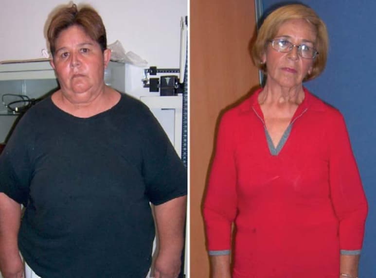 Con este procedimiento, se logró que Blanca mejorara su calidad de vida significativamente.