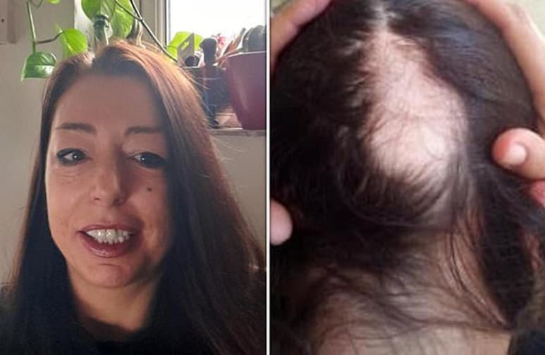 Dice que la pérdida de cabello que sufrió fue alarmante. (INTERNET)