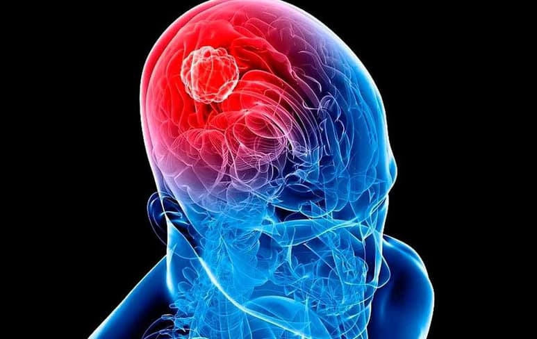 Un equipo de investigadores ha descubierto que una terapia combinada de dos medicamentos podría mejorar el tratamiento de los pacientes con los tumores cerebrales más frecuentes y agresivos, cuya tasa de supervivencia apenas ha mejorado en los últimos cincuenta años. (ESPECIAL)