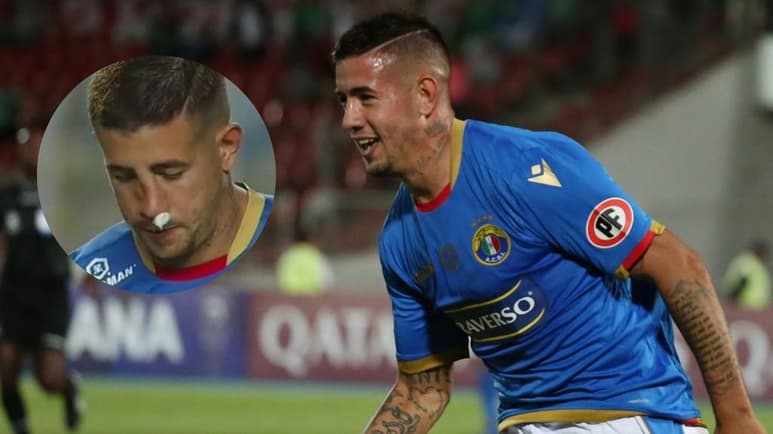 La imagen de la fractura de nariz que sufrió durante un partido el atacante del Audax Italiano, Rodrigo Holgado, ha impactado aún más luego de que el futbolista decidiera jugar así 80 minutos de un partido en la liga chilena.  (ARCHIVO/ESPECIAL)