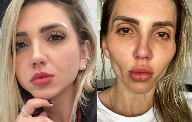 La 'influencer' compartió un antes y después de la bichectomía en Instagram (CAPTURA)