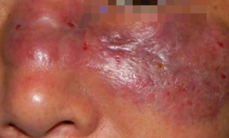 Según El Universal, Gregorio, el joven de 34 años afectado, presenta síntomas de mucormicosis. (ESPECIAL)