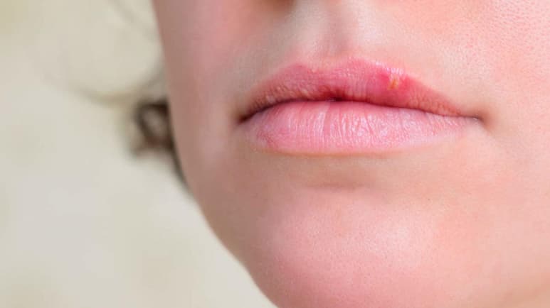 Los virus humanos de herpes simplex mutan 'in vitro' más rápido de lo que se pensaba, según un estudio español, el cual indica que el virus que causa el herpes genital, es capaz de evolucionar más rápido que su homólogo labial en cultivo celular. (ESPECIAL)