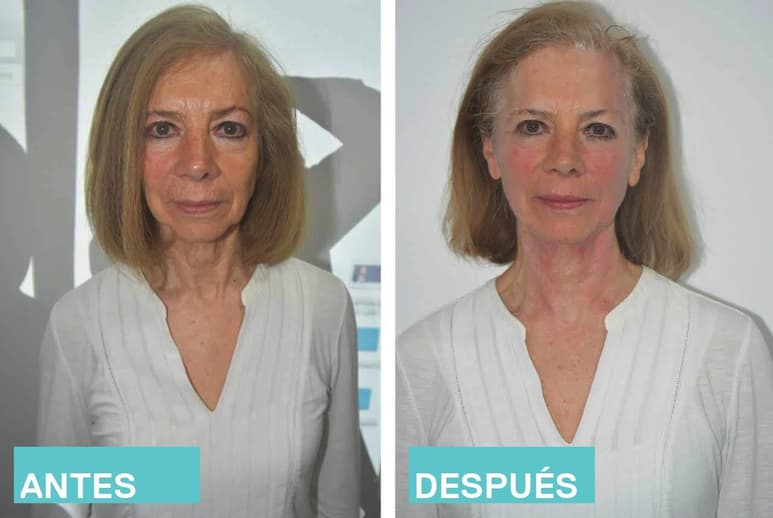 El Ultraformer es uno de los procedimientos más efectivos que pueden ayudar a esta piel a recobrar su calidad y belleza. (ESPECIAL)