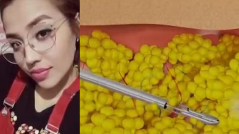 Con la intención de eliminar grasa de su cuerpo, una mujer de nombre Cinthia Lizeth Vega perdió la vida este 5 de octubre mediante el procedimiento llamado Agualipo. (ESPECIAL)