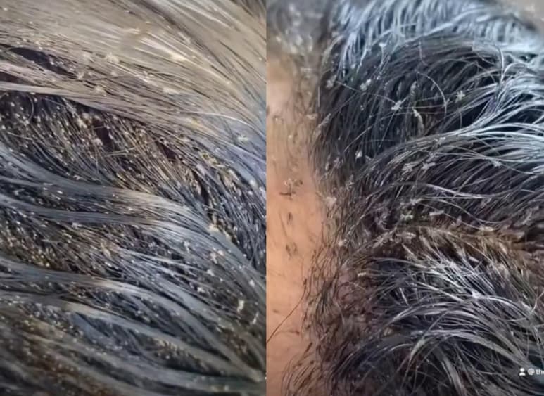 A través de TikTok, el centro de salud que atendió el caso de la niña compartió un video donde se aprecia la cabeza de ésta llena de miles de piojos (CAPTURA)