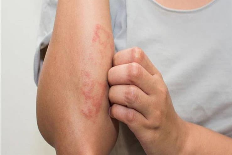 Las lesiones cutáneas que son más claras o rojizas que el color normal de la piel; provocan una disminución de la sensibilidad al tacto, al calor o al dolor. (ESPECIAL)