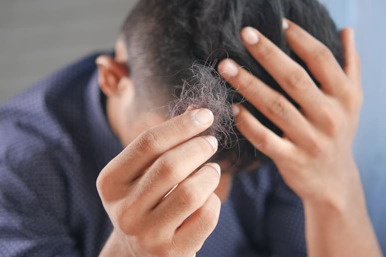 Los alimentos que aceleran la caída del cabello