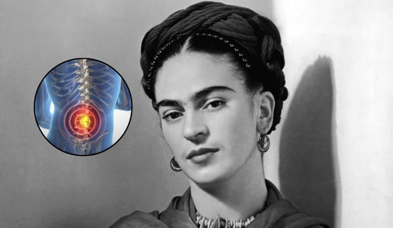 ¿Qué es el síndrome de la cola de caballo que padeció Frida Kahlo?