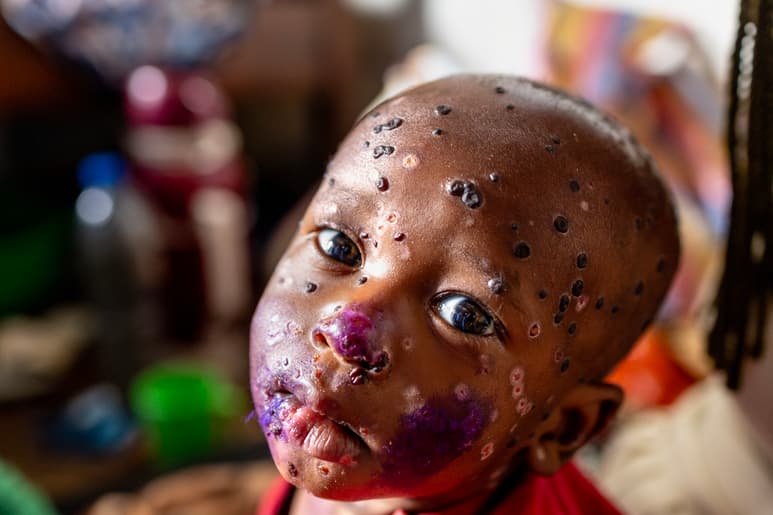 África registra más de 111 mil casos de mpox, van más de mil 700 muertos