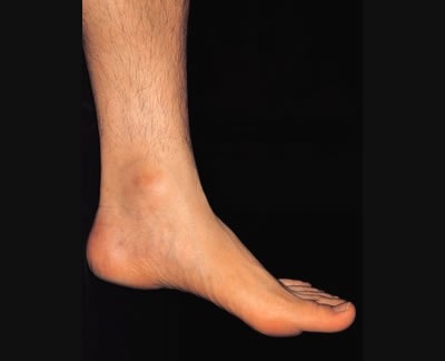 Los espolones suelen aparecer en los pies y son un indicio de la aparición de la espondilitis anquilosante, una enfermedad reumática, crónica y progresiva. 