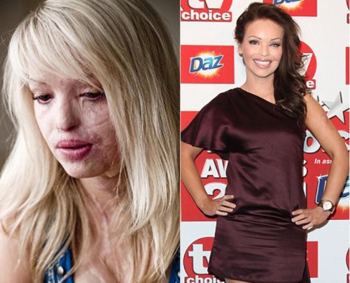 La modelo Katie Piper lució su rostro recuperado tras el ataque que sufrió en el 2008.(Dailymail.com)