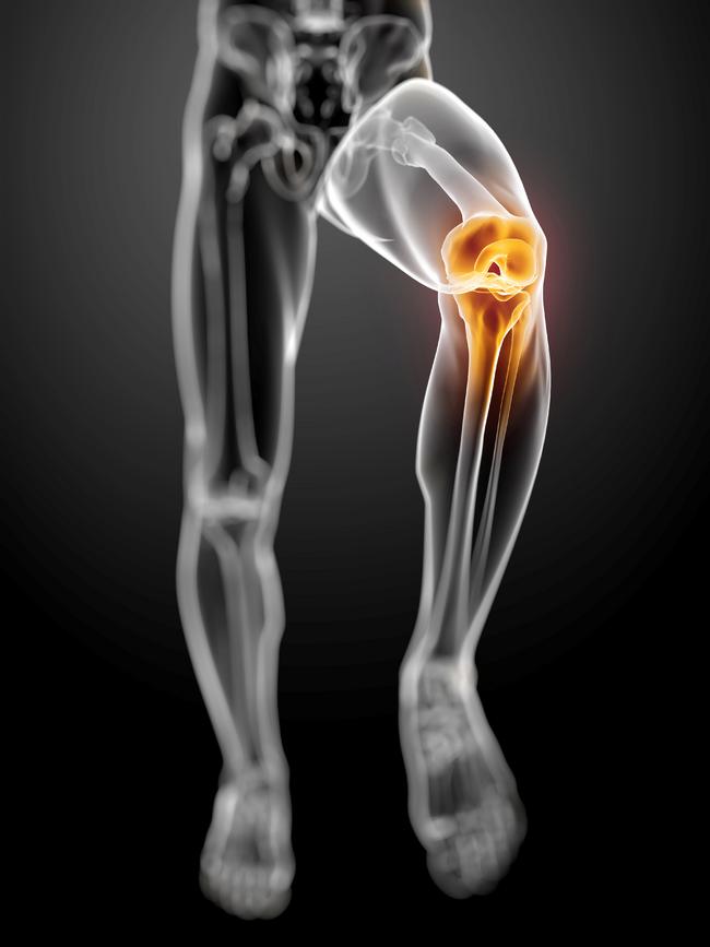 Los riesgos de la Osteoartritis