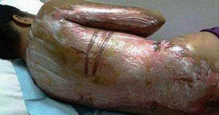 La muchacha quien fue nombrada como 'Fatma' sufrió graves quemaduras en su espalda. (Foto de: Dailymail.co.uk)