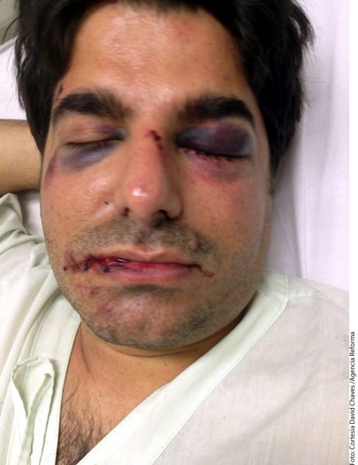 Agredido. Así quedó el rostro de David Chaves, el brasileño agredido por los mexicanos detenidos en Brasil.