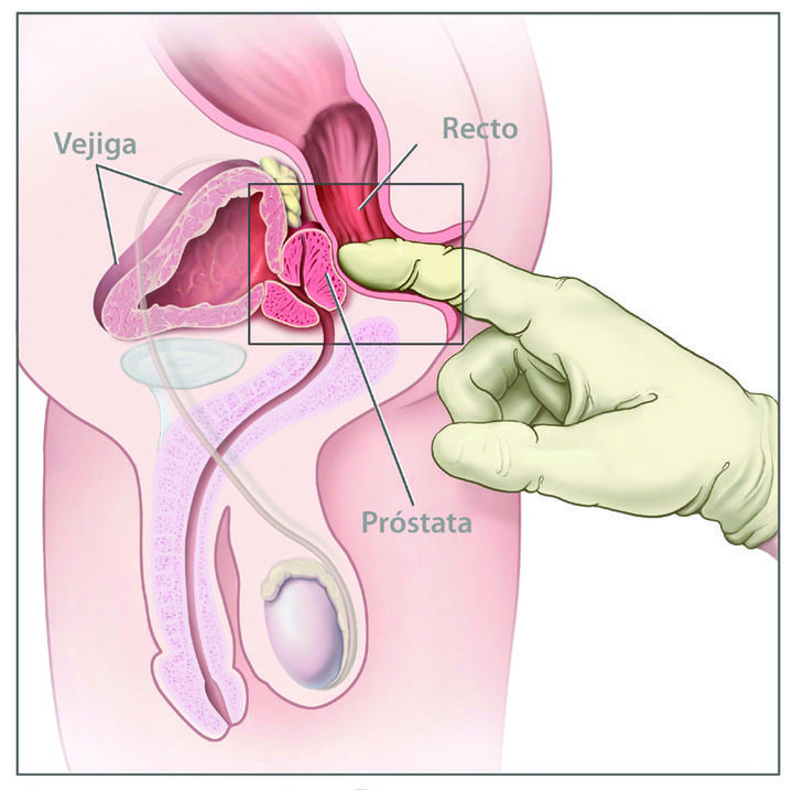 México contra el cáncer de próstata