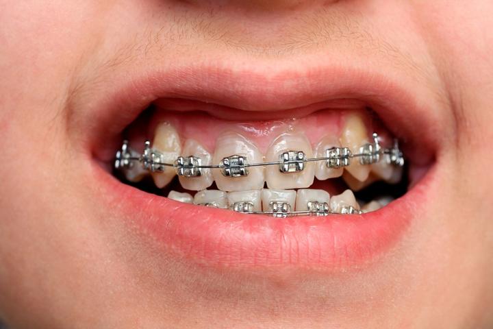 Por los componentes de los sistemas de adhesión, al desprender los brackets pueden causar microfracturas, acumulación de placa bacteriana y a veces caries. (ARCHIVO)