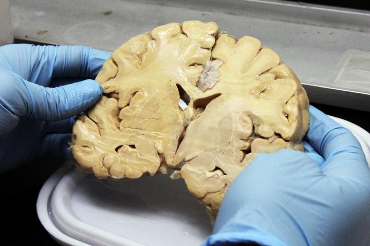 El centro, que cuenta hoy en día con 250 cerebros ya en custodia, lleva a cabo sus estudios seccionado los cerebros por la mitad. (ARCHIVO)