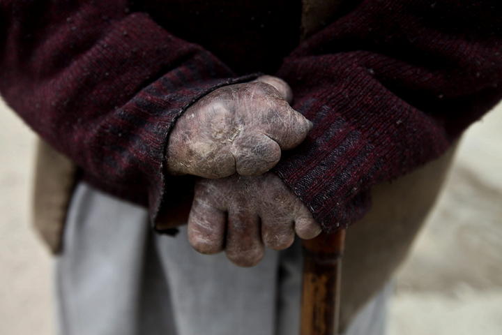 La lepra es una enfermedad crónica causada por el bacilo de Hansem que puede causar lesiones progresivas y permanentes en la piel, los nervios, las extremidades y los ojos. (ARCHIVO)