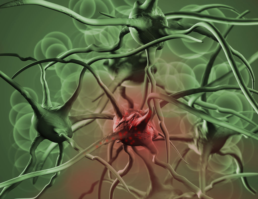 La metástasis consiste en una serie de pasos encadenados donde el tumor primario invade tejidos y acaba esparciéndose por todo el organismo. (ARCHIVO)