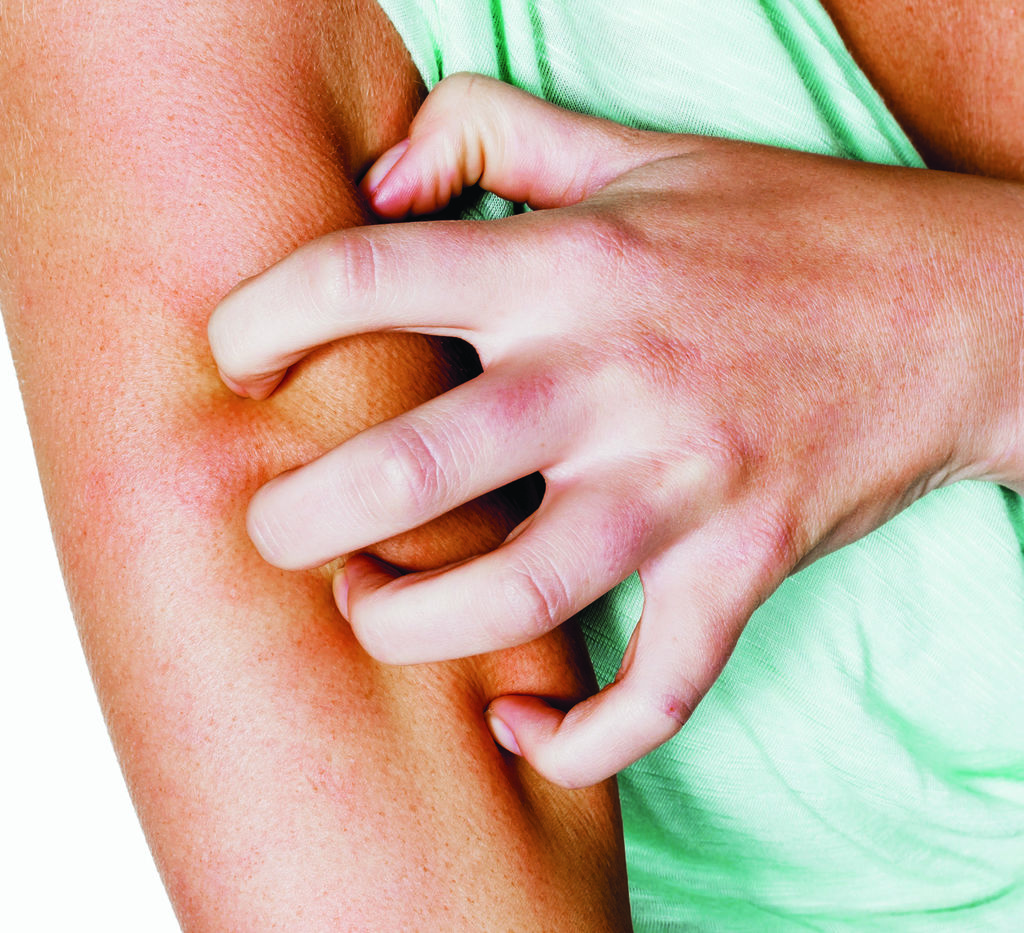 Dermatitis atópica