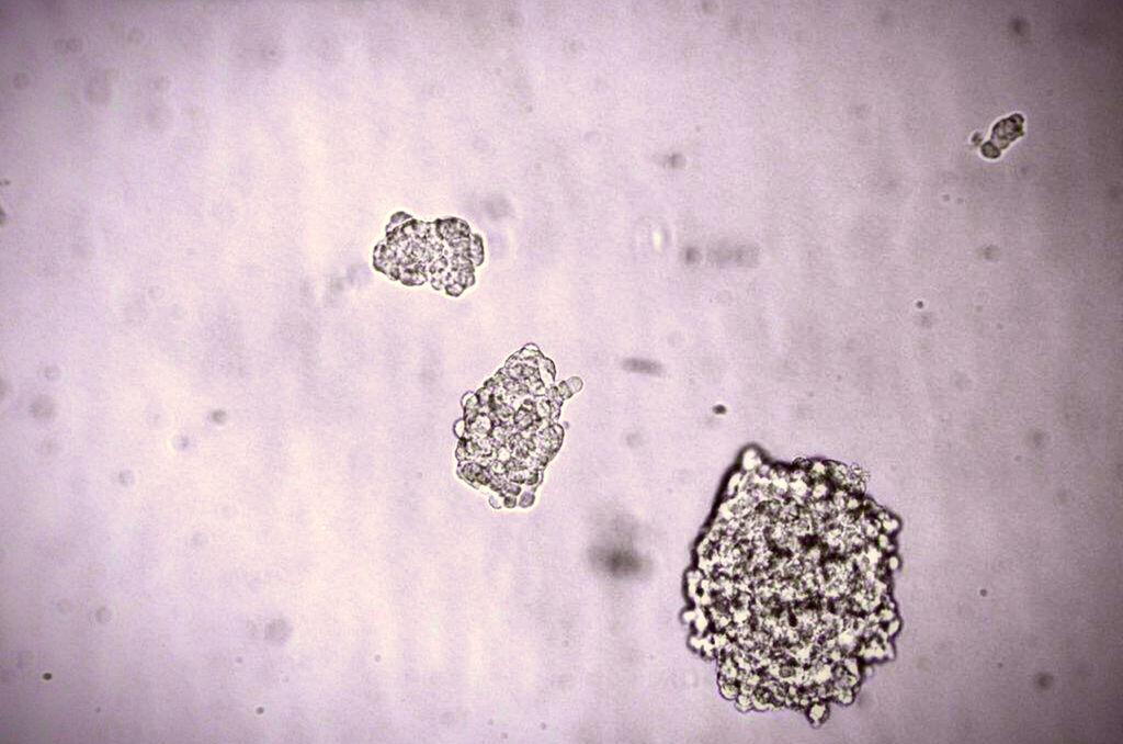 Se espera que las células madre embrionarias, capaces de transformarse en distintos tejidos, alivien los síntomas de la osteogénesis imperfecta, detectada en uno de cada 25,000 recién nacidos. (ARCHIVO)