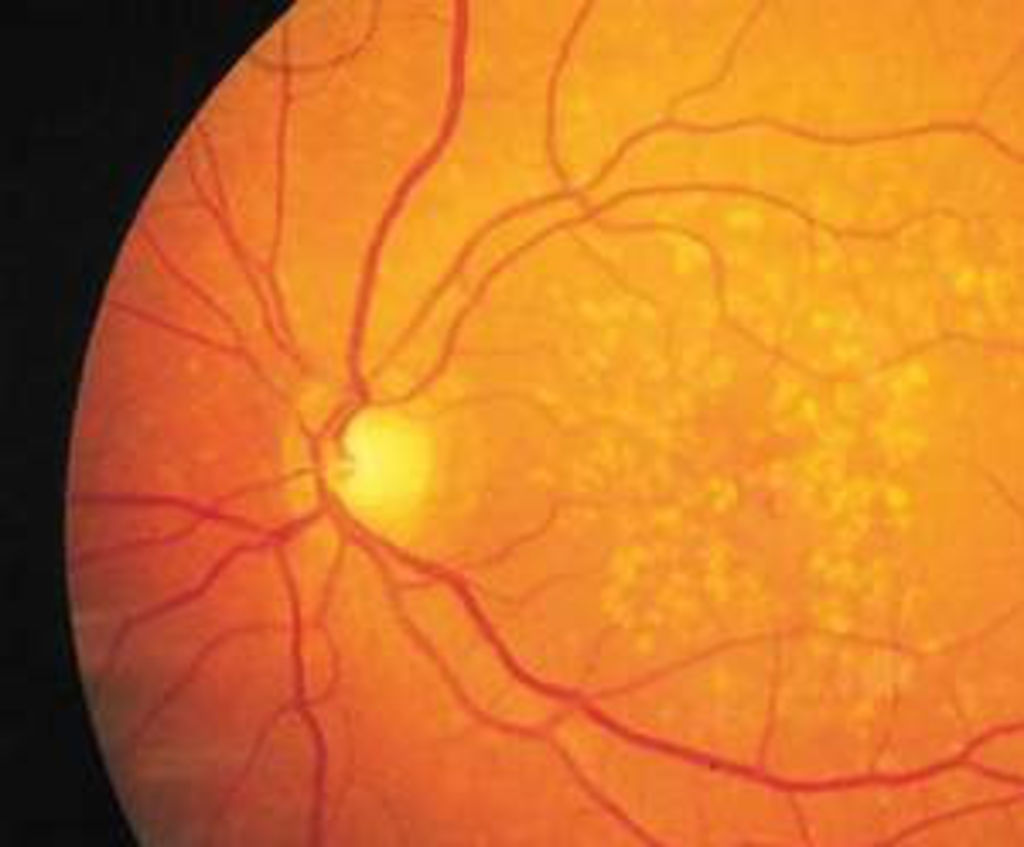 Esta enfermedad afecta a la mácula, una parte del ojo situada en el centro de la retina y cuya degradación no causa ceguera total pero hace que la visión pierda nitidez y se vuelva turbia y borrosa. (INTERNET)