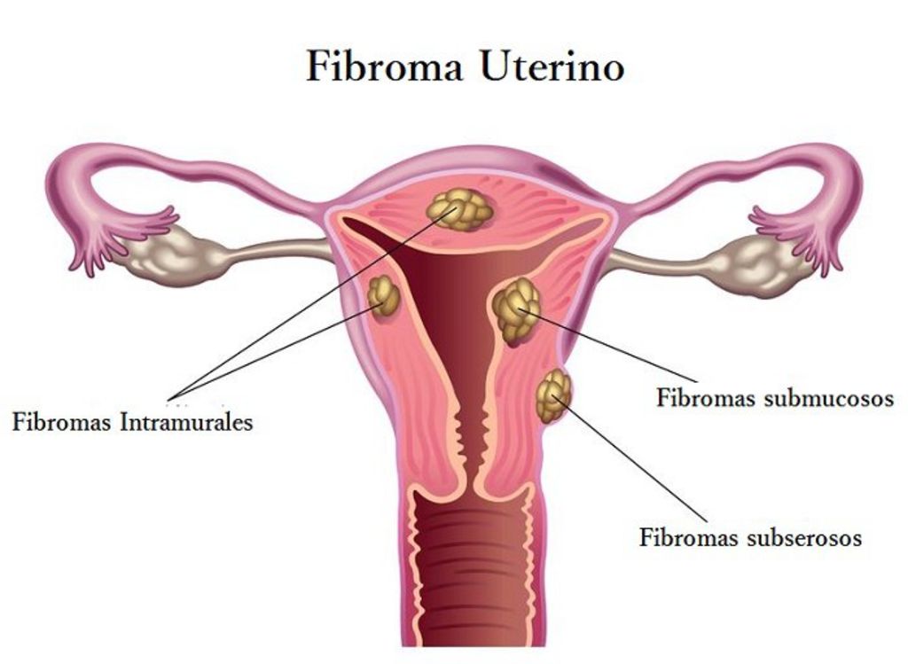 Cuando los fibromas uterinos provocan síntomas, los sangrados y los cólicos son los más comunes. (INTERNET)
