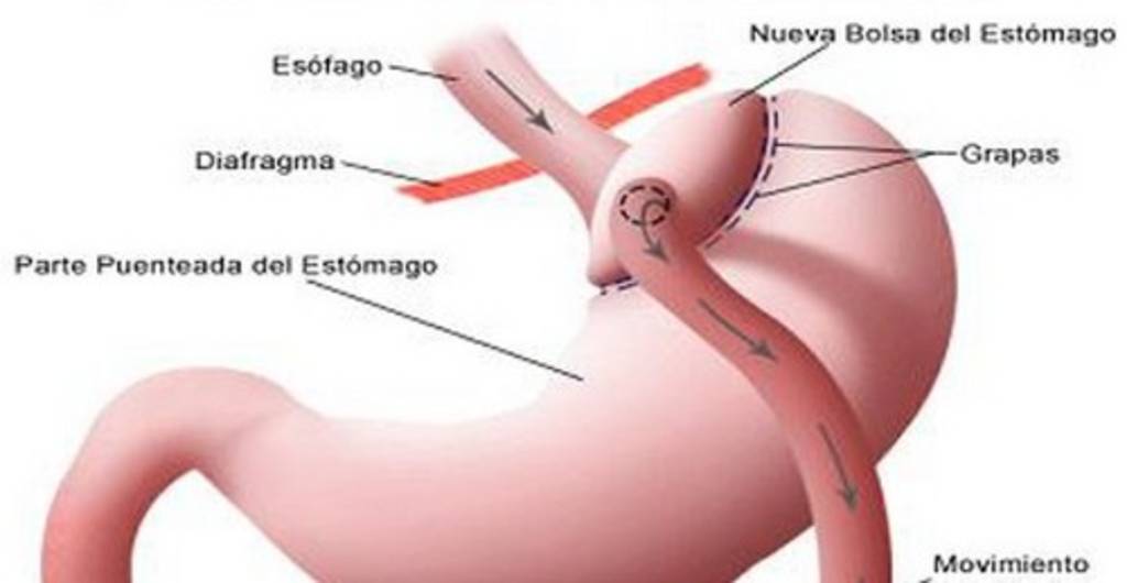 Cirugía. Más  de cinnco millones de niños en México tienen un problema de obesidad o sobrepeso.