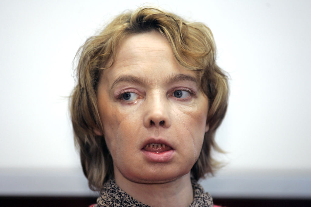 Dinoire había perdido los labios, parte de la nariz y la barbilla al ser atacada por su perra en mayo de 2005.  (AP)