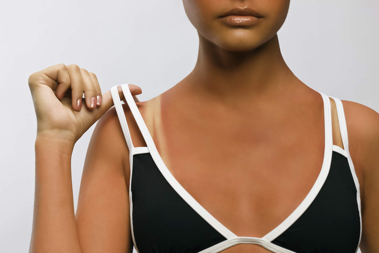 El cáncer de piel es el cáncer más común en Brasil.(INTERNET)