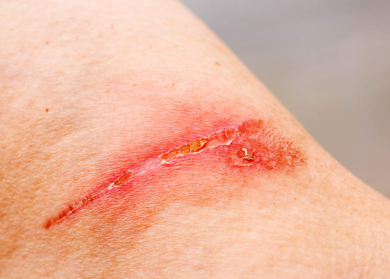 El fitofármaco acelera la cicatrización, lo que favorece el restablecimiento de la integridad del tejido, evita que las heridas se vuelvan crónicas o fibróticas y se puede emplear incluso para curar lesiones en órganos internos. (ARCHIVO)