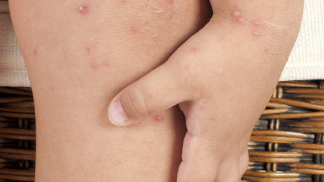 Los síntomas de la enfermedad son fiebre alta, malestar general, dolor de garganta, úlceras en la boca y salpullido en las extremidades. (ARCHIVO)