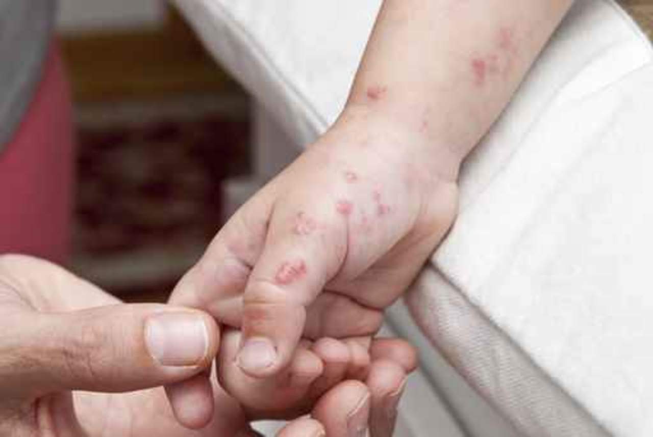 El virus coxsackie afecta sobre todo a menores de cinco años de edad, se puede propagar por contacto directo, heces fecales y secreciones respiratorias. (ARCHIVO)