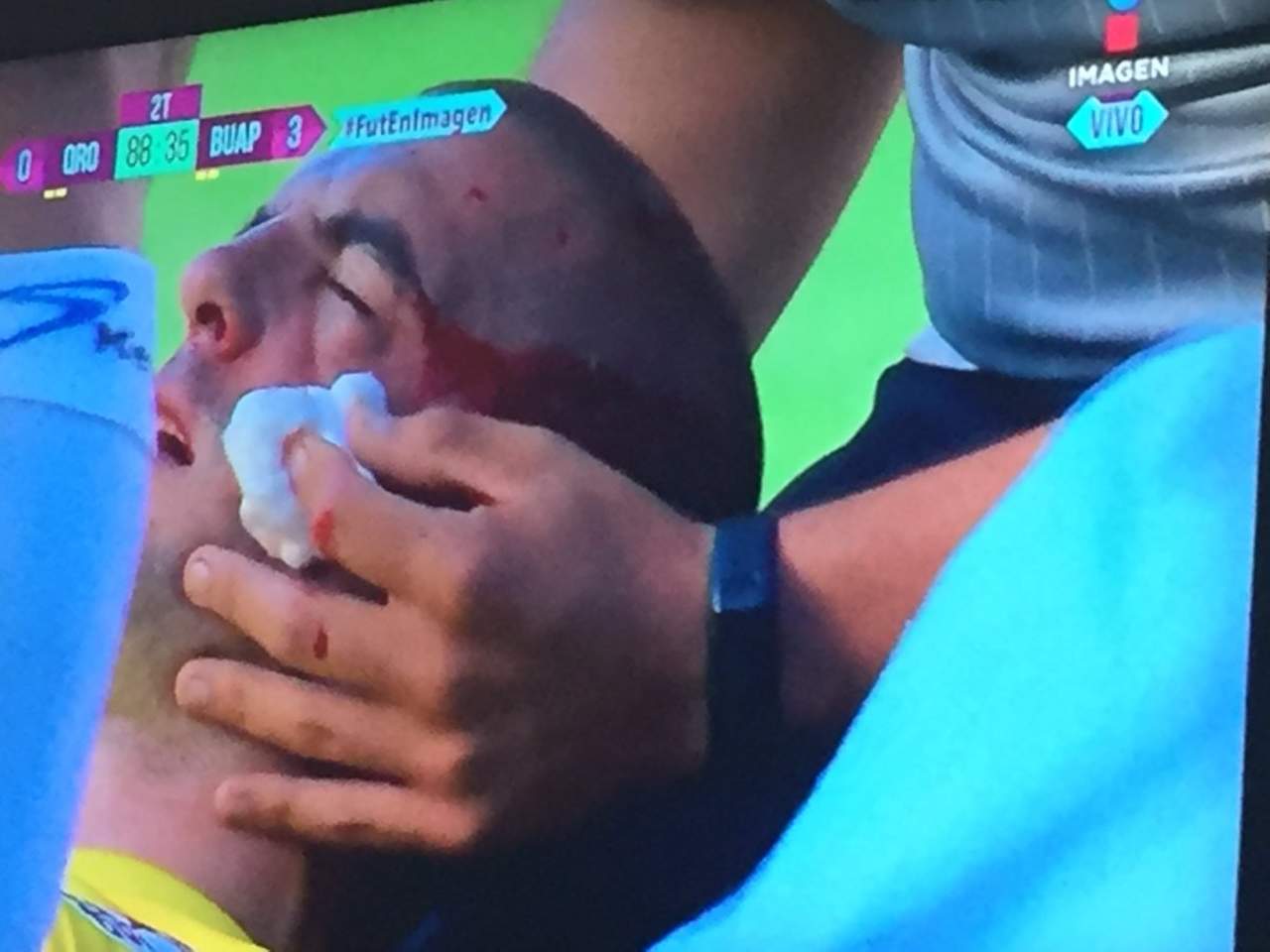Lucero Álvarez salió lesionado del encuentro ante Gallos de Querétaro. Según el informe el arquero estuvo a punto de perder el ojo por una fractura de pómulo, sin embargo no pasó a mayores.
