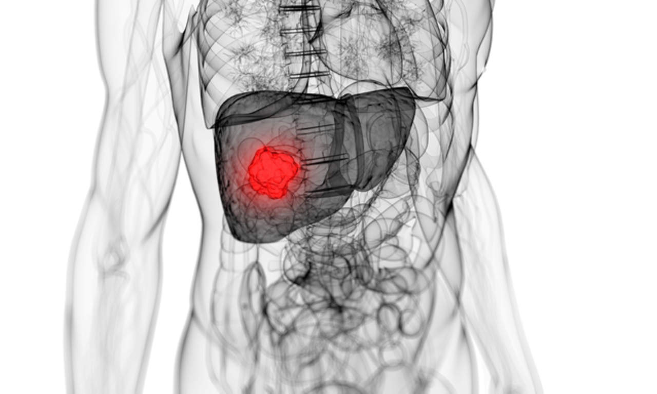 La incidencia del cáncer de hígado, también conocido como carcinoma hepatocelular, aumenta de manera sostenida y además se suele diagnosticar en un estadio muy tardío. (ARCHIVO)